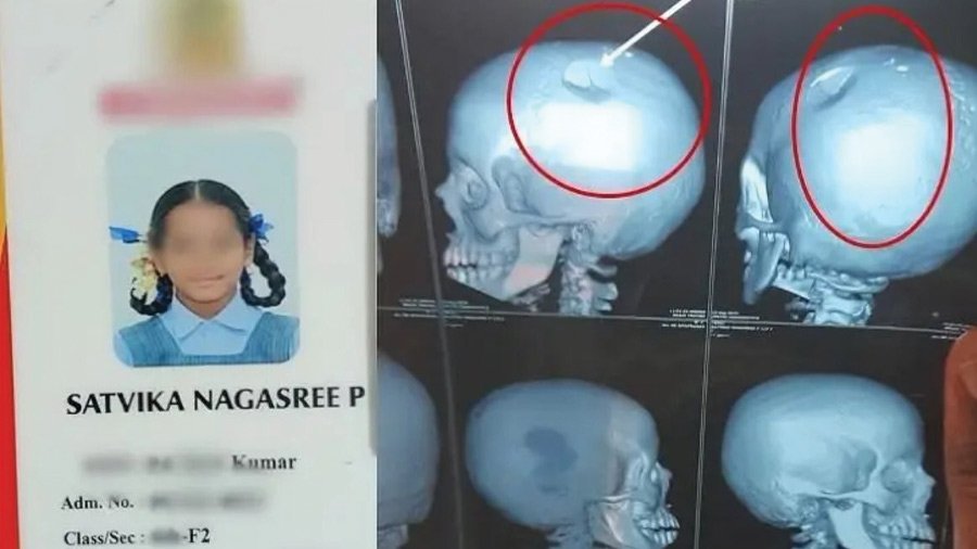 Parents seeking justice for girl with skull fracture after teacher assault in Andhra Pradesh
