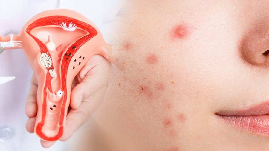 Woman experiencing brain fog and fatigue due to PCOS affecting work performance